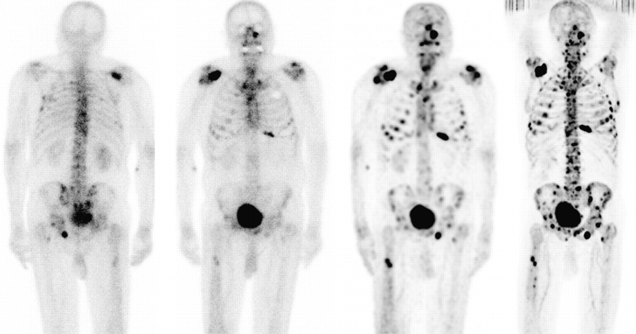 The Detection of Bone Metastases in Patients with High