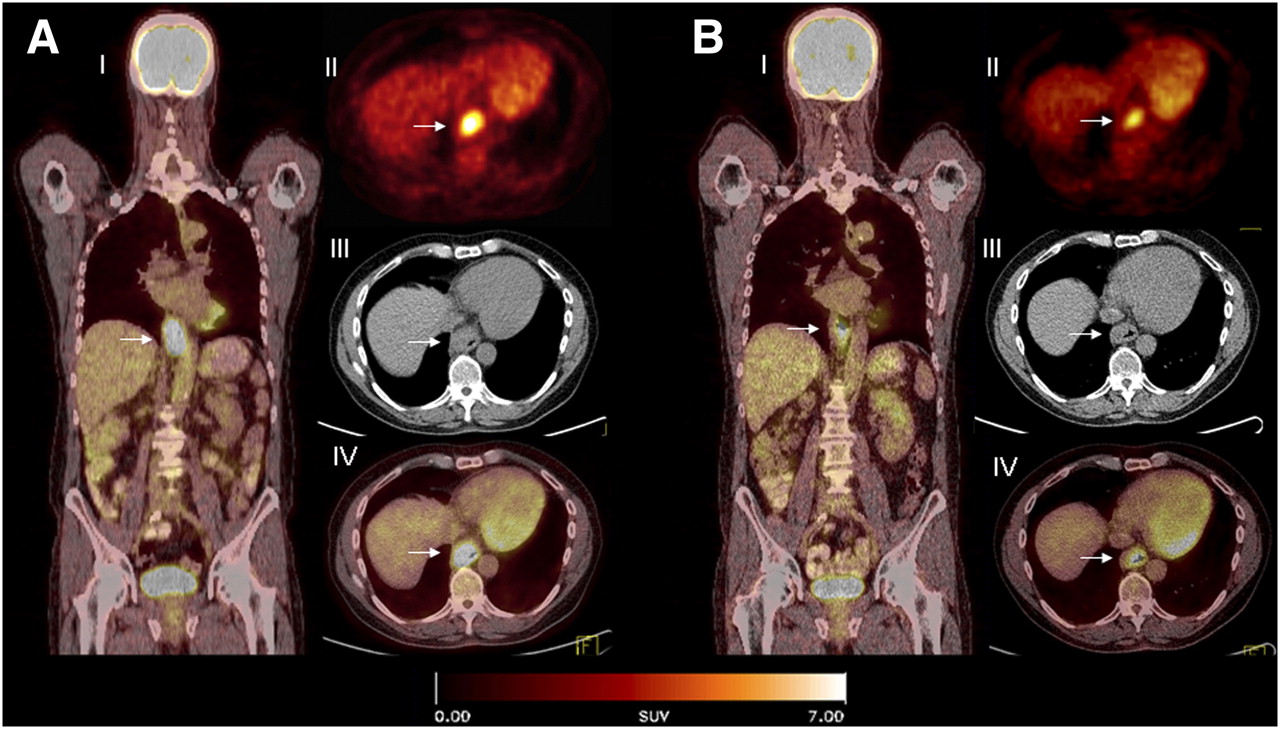 18F FDG PET And 18F FDG PET CT For Assessing Response To Therapy In 18f-fdg-pet-and-18f-fdg-pet-ct-for-assessing-response-to-therapy-in