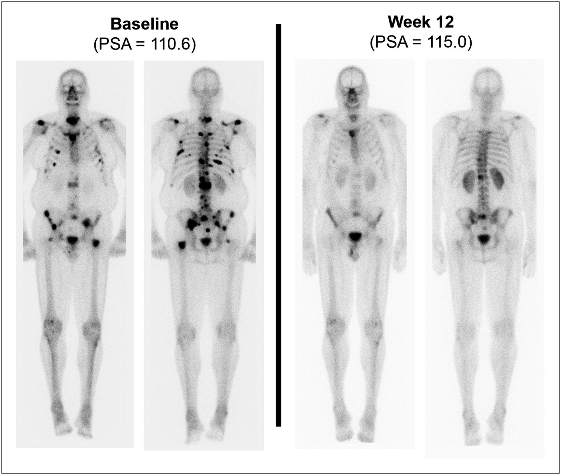 Prostate cancer bone scans