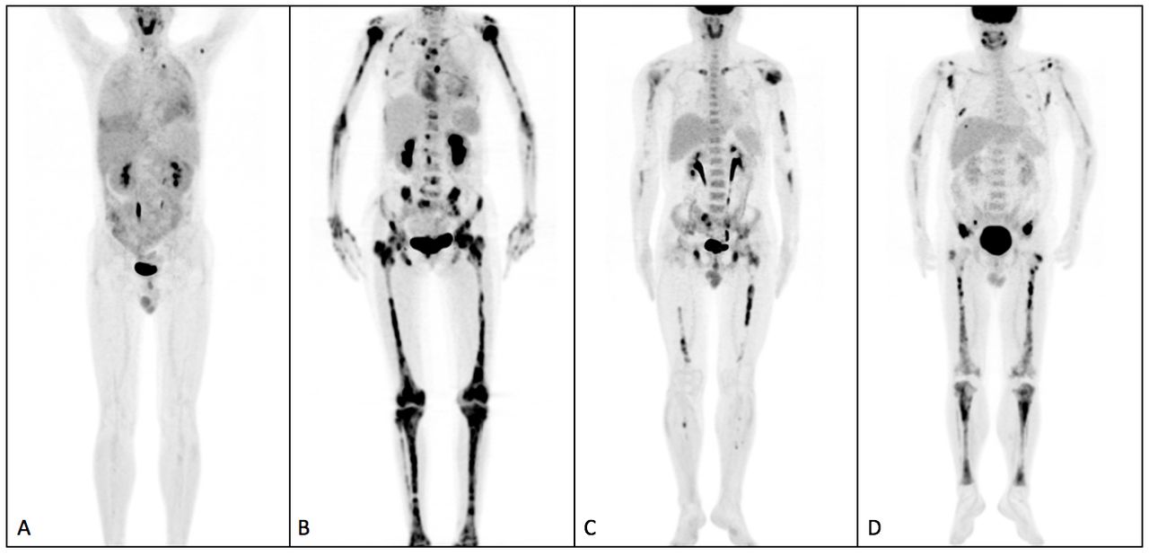 comparison-of-18f-fdg-pet-and-bone-scintigraphy-in-detection-of-bone