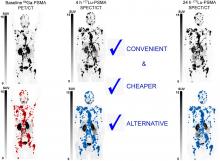 Comparison of Posttherapy 4- and 24-Hour [<sup>177</sup>Lu]Lu-PSMA SPECT/CT and Pretherapy PSMA PET/CT in Assessment of Disease in Men with Metastatic Castration-Resistant Prostate Cancer