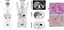 Impact of <sup>68</sup>Ga-FAPI PET/CT Imaging on the Therapeutic Management of Primary and Recurrent Pancreatic Ductal Adenocarcinomas