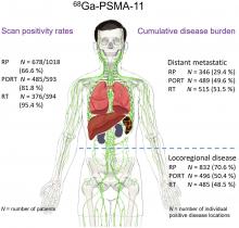
    A Comprehensive Assessment of <sup>68</sup>Ga-PSMA-11 PET in Biochemically Recurrent Prostate Cancer: Results from a Prospective Multicenter Study on 2,005 Patients
  
