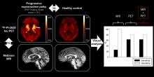 <sup>18</sup>F-PI-2620 Tau PET Improves the Imaging Diagnosis of Progressive Supranuclear Palsy