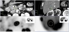 The Quest for an Accurate Functional Tumor Volume with <sup>68</sup>Ga-DOTATATE PET/CT