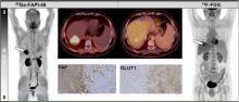 Superior Tumor Detection for <sup>68</sup>Ga-FAPI-46 Versus <sup>18</sup>F-FDG PET/CT and Conventional CT in Patients with Cholangiocarcinoma