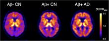 Assessing Reactive Astrogliosis with <sup>18</sup>F-SMBT-1 Across the Alzheimer Disease Spectrum