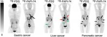 Fibroblast Activation Protein–Targeted PET/CT with <sup>18</sup>F-Fibroblast Activation Protein Inhibitor-74 for Evaluation of Gastrointestinal Cancer: Comparison with <sup>18</sup>F-FDG PET/CT