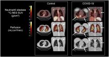 In Vivo Visualization and Quantification of Neutrophil Elastase in Lungs of COVID-19 Patients: A First-in-Humans PET Study with <sup>11</sup>C-NES