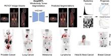 Deep Semisupervised Transfer Learning for Fully Automated Whole-Body Tumor Quantification and Prognosis of Cancer on PET/CT