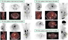 Fetal Dose from PET and CT in Pregnant Patients
