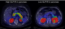 Glucagonlike Peptide-1 Receptor Imaging in Individuals with Type 2 Diabetes