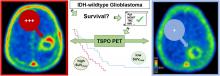 Prognostic Value of TSPO PET Before Radiotherapy in Newly Diagnosed IDH–Wild-Type Glioblastoma