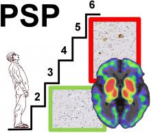 In Vivo <sup>18</sup>F-Flortaucipir PET Does Not Accurately Support the Staging of Progressive Supranuclear Palsy