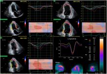 Left Ventricular Strain from Myocardial Perfusion PET Imaging: Method Development and Comparison to 2-Dimensional Echocardiography