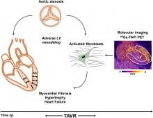 Molecular Imaging of Myocardial Fibroblast Activation in Patients with Advanced Aortic Stenosis Before Transcatheter Aortic Valve Replacement: A Pilot Study