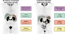 Antihormonal-Treatment Status Affects <sup>68</sup>Ga-PSMA-HBED-CC PET Biodistribution in Patients with Prostate Cancer