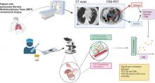 [<sup>18</sup>F]FDG PET/CT Signal Correlates with Neoangiogenesis Markers in Patients with Fibrotic Interstitial Lung Disease Who Underwent Lung Biopsy: Implication for the Use of PET/CT in Diffuse Lung Diseases