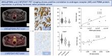 Consecutive Prostate-Specific Membrane Antigen (PSMA) and Antigen Receptor (AR) PET Imaging Shows Positive Correlation with AR and PSMA Protein Expression in Primary Hormone-Naïve Prostate Cancer