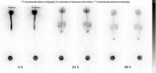 Radioimmunoscintigraphy and Pretreatment Dosimetry of <sup>131</sup>I-Omburtamab for Planning Treatment of Leptomeningeal Disease
