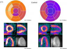 Cardiac Presynaptic Sympathetic Nervous Function Evaluated by Cardiac PET in Patients with Chronotropic Incompetence Without Heart Failure