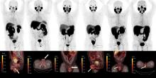 Prostate Cancer Recurrence Due to Isolated Testicular Metastases Detected by PSMA PET/CT