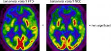 Frontal Hypometabolism in Neurocognitive Disorder with Behavioral Disturbance