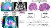 Clinical, Pathologic, and Imaging Variables Associated with Prostate Cancer Detection by PSMA PET/CT and Multiparametric MRI