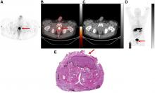 Correlation of <sup>68</sup>Ga-RM2 PET with Postsurgery Histopathology Findings in Patients with Newly Diagnosed Intermediate- or High-Risk Prostate Cancer