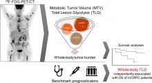 Quantification of Metastatic Prostate Cancer Whole-Body Tumor Burden with <sup>18</sup>F-FDG PET Parameters and Associations with Overall Survival After First-Line Abiraterone or Enzalutamide: A Single-Center Retrospective Cohort Study