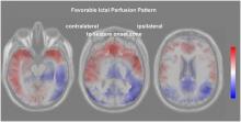 Predicting the Outcome of Epilepsy Surgery by Covariance Pattern Analysis of Ictal Perfusion SPECT