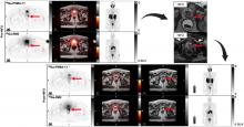 A Pilot Study of <sup>68</sup>Ga-PSMA11 and <sup>68</sup>Ga-RM2 PET/MRI for Evaluation of Prostate Cancer Response to High-Intensity Focused Ultrasound Therapy