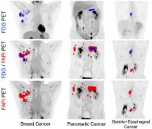 Initial Evaluation of [<sup>18</sup>F]FAPI-74 PET for Various Histopathologically Confirmed Cancers and Benign Lesions