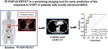 Response Prediction Using <sup>18</sup>F-FAPI-04 PET/CT in Patients with Esophageal Squamous Cell Carcinoma Treated with Concurrent Chemoradiotherapy