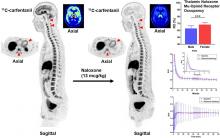 [<sup>11</sup>C]Carfentanil PET Whole-Body Imaging of μ-Opioid Receptors: A First in-Human Study