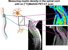 Myelin Imaging of the Spinal Cord in Animal Models and Patients with Multiple Sclerosis Using [<sup>11</sup>C]MeDAS PET: A Translational Study