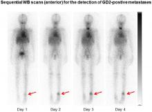<sup>131</sup>I-GD2-ch14.18 Scintigraphy to Evaluate Option for Radioimmunotherapy in Patients with Advanced Tumors
