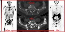 The Tyr Phenomenon: A Hypocalcemic Response in High-Volume Treatment Responders to <sup>177</sup>Lu-Prostate-Specific Membrane Antigen Therapy