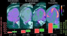 Factors Associated with Myocardial Uptake on Oncologic Somatostatin PET Investigations and Differentiation from Myocardial Uptake of Acute Myocarditis