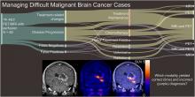 Hybrid <sup>18</sup>F-Fluoroethyltyrosine PET and MRI with Perfusion to Distinguish Disease Progression from Treatment-Related Change in Malignant Brain Tumors: The Quest to Beat the Toughest Cases