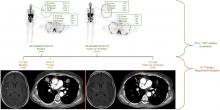 <sup>18</sup>F-BMS986192 PET Imaging of PD-L1 in Metastatic Melanoma Patients with Brain Metastases Treated with Immune Checkpoint Inhibitors: A Pilot Study