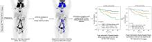 <sup>18</sup>F-FDG PET Maximum-Intensity Projections and Artificial Intelligence: A Win-Win Combination to Easily Measure Prognostic Biomarkers in DLBCL Patients