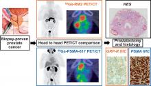 Comparison of <sup>68</sup>Ga-PSMA-617 PET/CT and <sup>68</sup>Ga-RM2 PET/CT in Patients with Localized Prostate Cancer Who Are Candidates for Radical Prostatectomy: A Prospective, Single-Arm, Single-Center, Phase II Study
