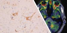 Relationship Between <sup>18</sup>F-Flortaucipir Uptake and Histologic Lesion Types in 4-Repeat Tauopathies