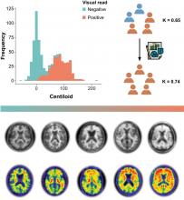 Quantification Supports Amyloid PET Visual Assessment of Challenging Cases: Results from the AMYPAD Diagnostic and Patient Management Study