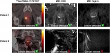 Diagnostic Performance of <sup>68</sup>Ga-PSMA-11 PET/CT Versus Multiparametric MRI for Detection of Intraprostatic Radiorecurrent Prostate Cancer