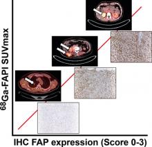 <sup>68</sup>Ga-FAPI as a Diagnostic Tool in Sarcoma: Data from the <sup>68</sup>Ga-FAPI PET Prospective Observational Trial