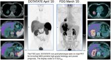 Dual PET Imaging in Bronchial Neuroendocrine Neoplasms: The NETPET Score as a Prognostic Biomarker