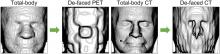 Facial Anonymization and Privacy Concerns in Total-Body PET/CT