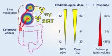The Impact of Radiobiologically Informed Dose Prescription on the Clinical Benefit of <sup>90</sup>Y SIRT in Colorectal Cancer Patients